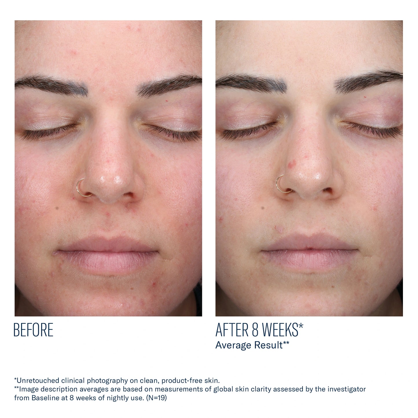 Before and after 8 weeks of SkinBetter AlphaRet Clearing Serum showing improved skin clarity and reduced acne appearance