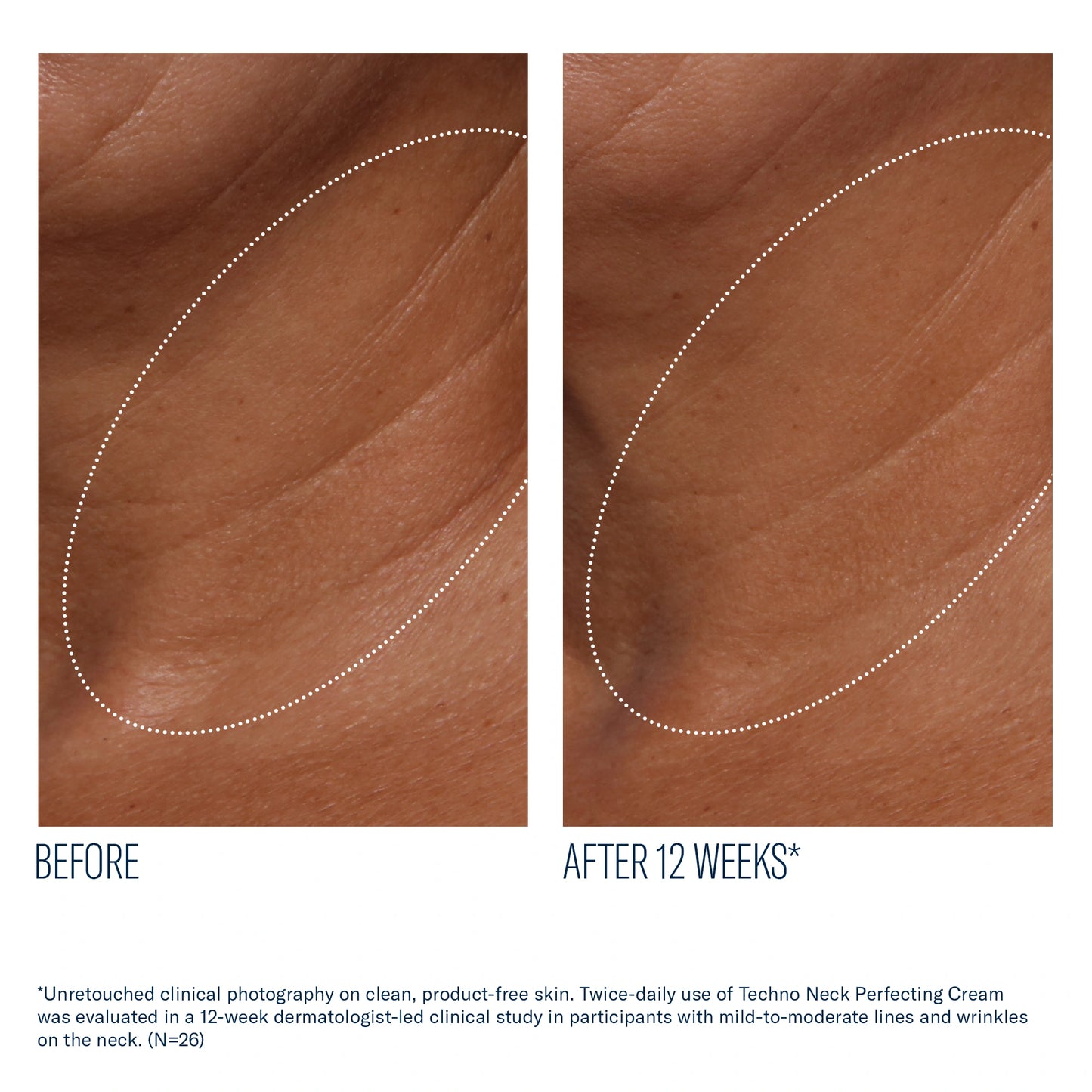 Before and after 12 weeks of SkinBetter Techno Neck Perfecting Cream showing reduced neck lines and smoother skin