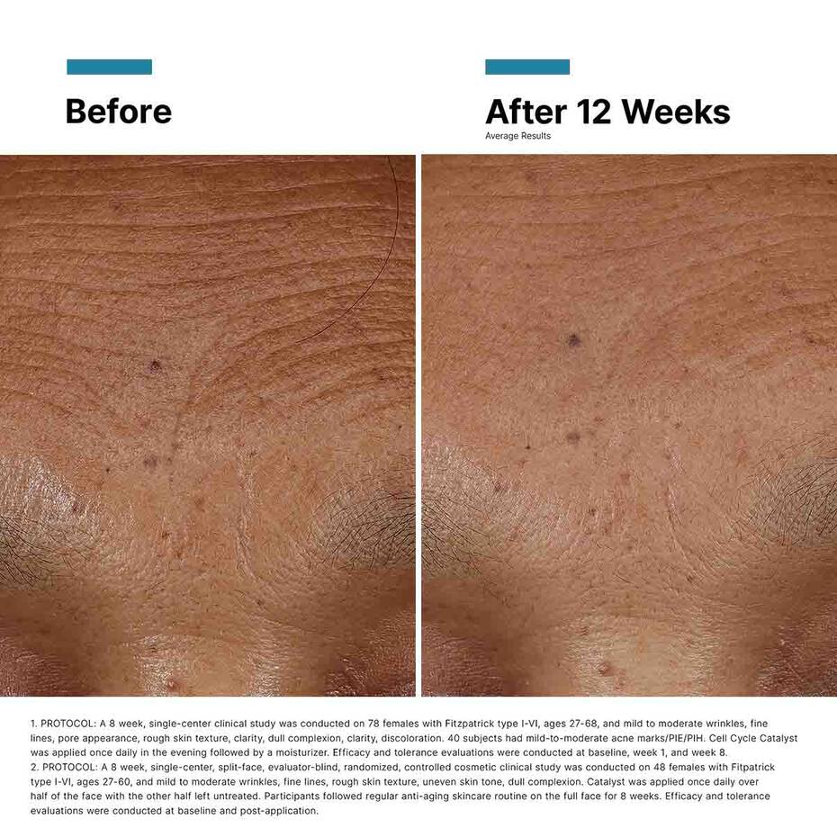 Before and after 12 weeks photo showing smoother forehead lines after using SkinCeuticals H.A. Intensifier serum for volume.