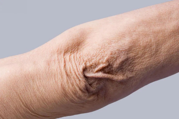 How to Fix Crepey Skin on Arms and Knees