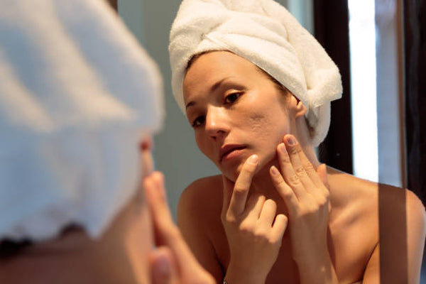woman with acne scars