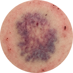 Bruising + Laser Care