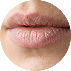 Chapped Lips