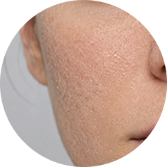 Dry Skin