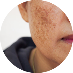 Hyperpigmentation + Sun Spots