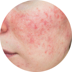 Rosacea
