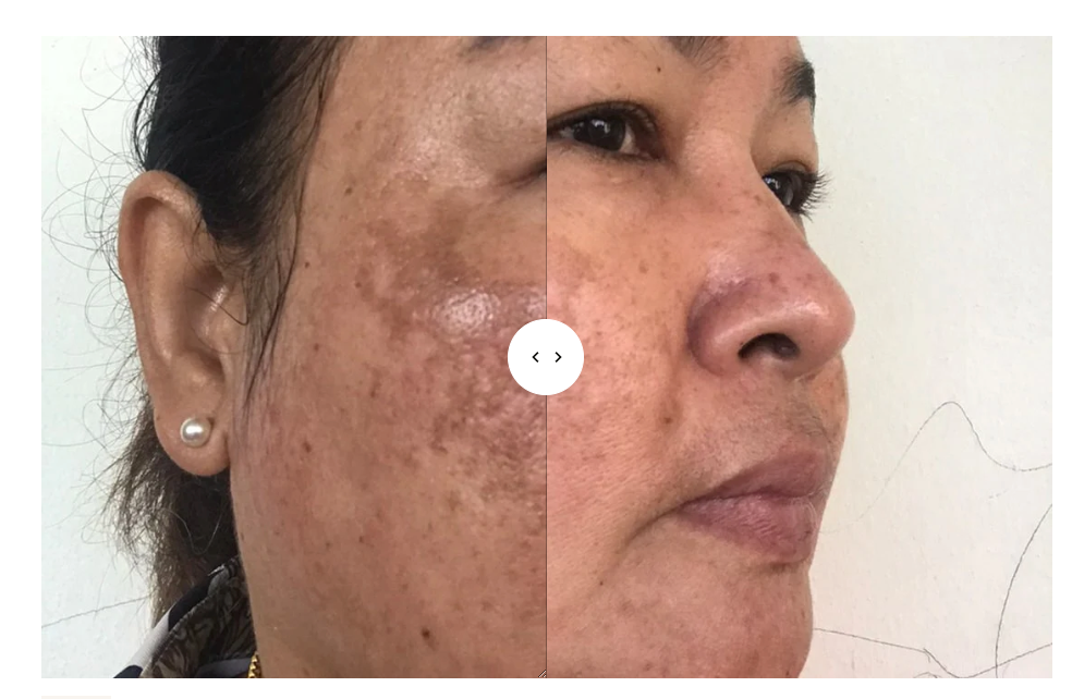 Sente- Cysteamine HSA Pigment & Tone Corrector