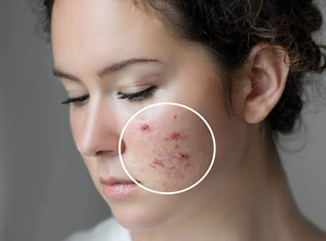 What Causes Acne?
