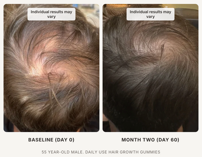 Xtressé Hair Growth Gummies