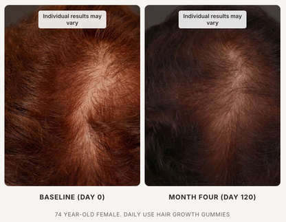 Xtressé Hair Growth Gummies