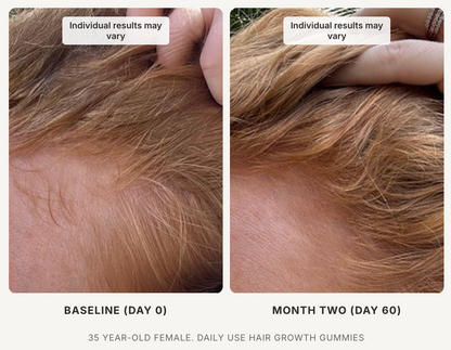 Xtressé Hair Growth Gummies