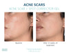 Silagen- Acne Scar + Spot Corrector