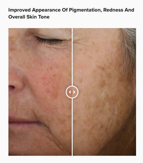 Alastin A-Luminate Brightening Serum before and after showing reduced dark spots improved skin tone and brighter complexion