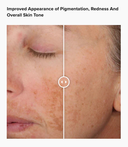 Before and after using Alastin A-LUMINATE Brightening Serum, reduced pigmentation and redness, improved skin tone