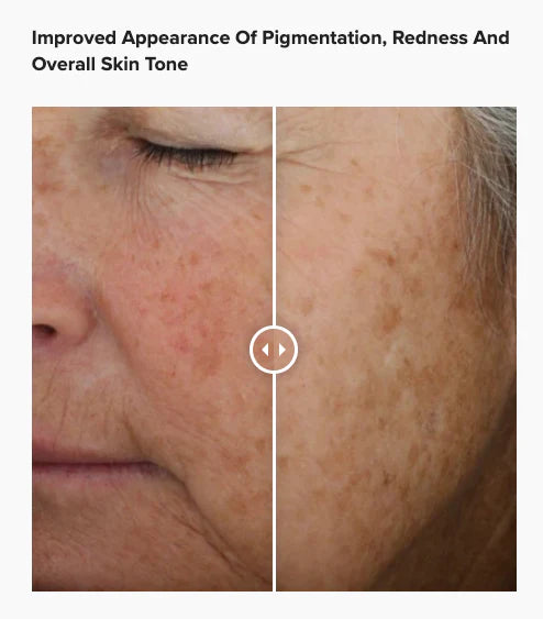 Before and after using Alastin A-LUMINATE Serum, noticeable reduction in facial pigmentation and redness, enhanced overall skin tone