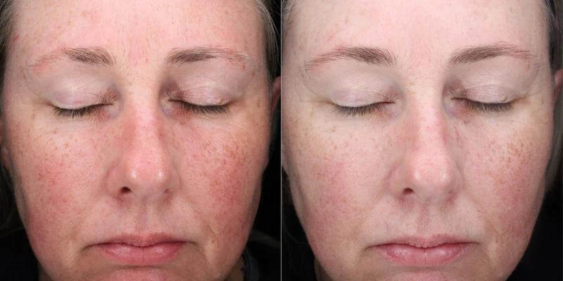 alastin c-radical defense antioxidant serum before and after results showing improved skin appearance