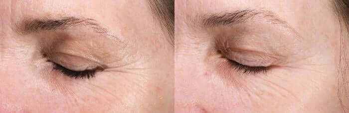 Before and after using Alastin Restorative Eye Treatment showing reduced eye wrinkles and smoother under eye skin