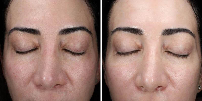 before and after results of alastin ha immerse serum showing improved skin hydration smoother texture and glow
