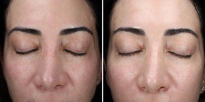 before and after results of alastin ha immerse serum showing improved skin hydration smoother texture and glow