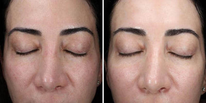 before and after results of alastin ha immerse serum showing improved skin hydration smoother texture and glow