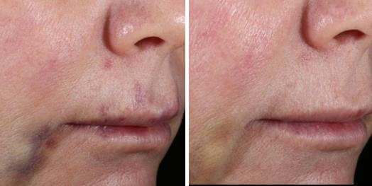 Before and after facial bruising photos showing post injection discoloration changes around cheek and mouth areas after care