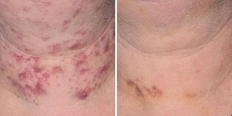 Before and after neck bruising photos showing visible post injection skin discoloration changes with serum support care uses