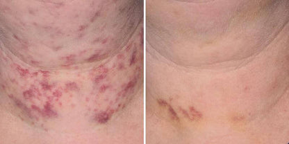 Before and after neck bruising photos showing visible post injection skin discoloration changes with serum support care uses