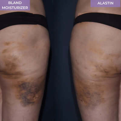 Alastin ReFORM & RePAIR Complex before and after results showing improved skin tone and reduced discoloration on legs