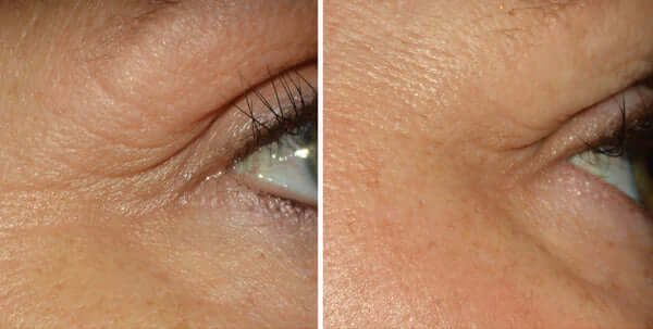 Before and after using Alastin Restorative Eye Treatment showing reduced fine lines and smoother under eye texture
