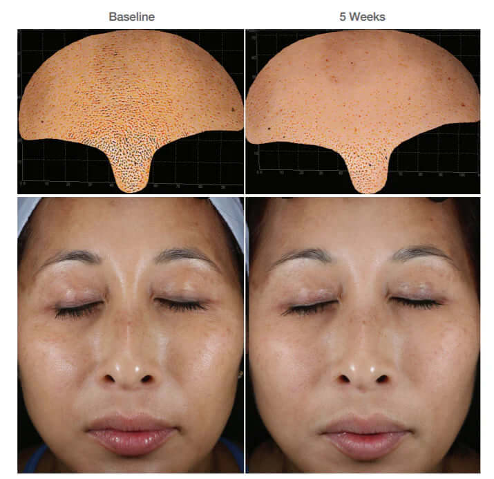 Before and after 5 weeks of Alastin Restorative Skin Complex showing improved skin tone clarity and smoothness