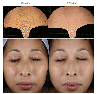 Before and after 5 weeks of Alastin Restorative Skin Complex showing improved skin tone clarity and smoothness