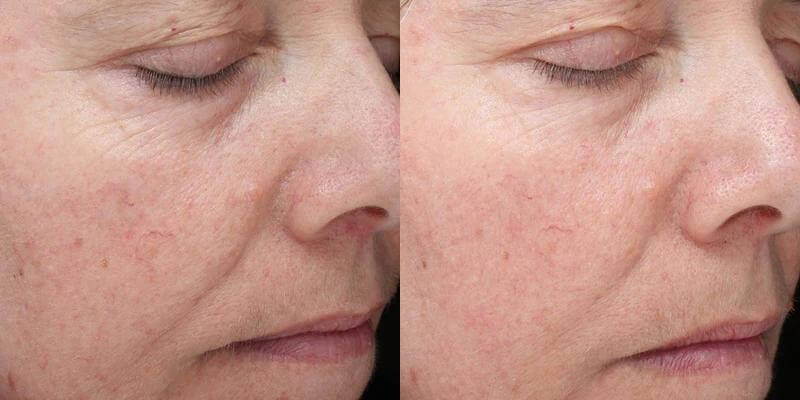 Before and after using Alastin Restorative Skin Complex showing reduced fine lines wrinkles and smoother skin