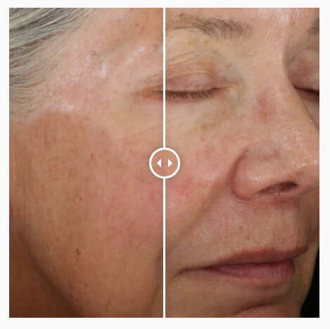 Before and after using Alastin ReSurface Skin Polish by Alastin Skincare showing smoother skin texture and improved tone