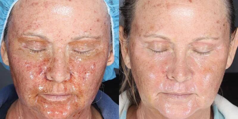 Before and after post procedure skin recovery showing improved healing and reduced redness with Alastin Skin Nectar serum