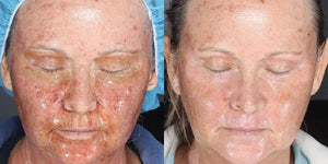 Before and after post procedure skin recovery showing improved healing and reduced redness with Alastin Skin Nectar serum