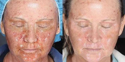 Before and after post procedure skin recovery showing improved healing and reduced redness with Alastin Skin Nectar serum