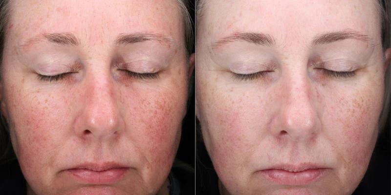 Before and after using Alastin C-Radical Defense Serum, reduced redness and improved skin tone