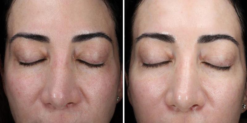 Before and after using Alastin HA Immerse Serum, enhanced skin hydration and visible reduction in fine lines