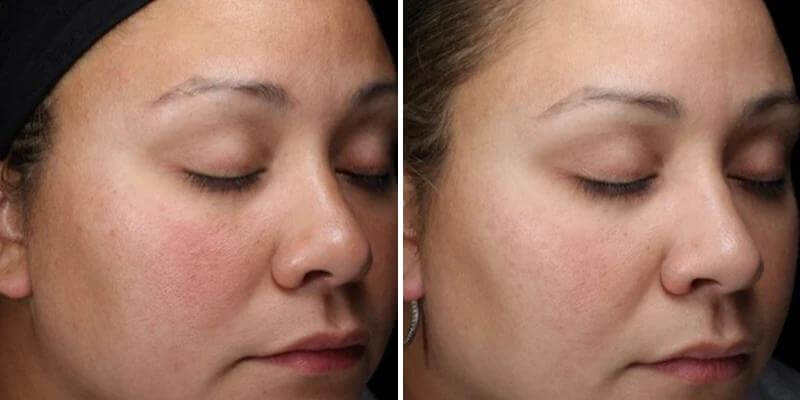 before and after using alastin ha immerse serum showing reduced redness, improved skin tone and smoother texture