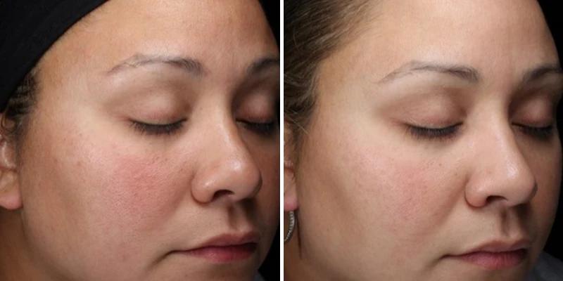 Before and after using Alastin HA Immerse Serum, noticeable skin hydration and smoother complexion