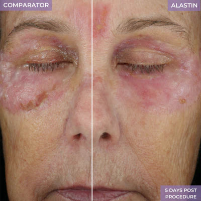 Before and after using Alastin Procedure Enhancement System, improved recovery and reduced redness 5 days post-procedure