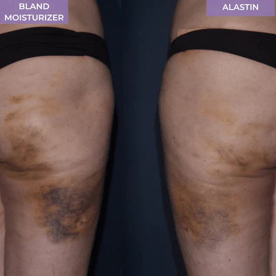 Before and after using Alastin ReFORM & RePAIR Complex, reduced bruising and improved skin appearance