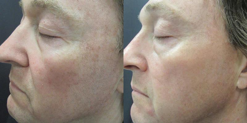 Before and after using Alastin Regenerating Skin Nectar, improved skin texture and tone