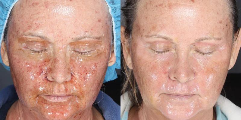 Before and after using Alastin Regenerating Skin Nectar, improved recovery and skin appearance post-treatment