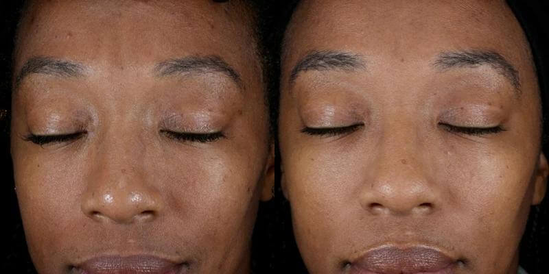 Alastin Skincare Renewal Retinol 0.5 before and after results showing smoother skin and reduced fine lines