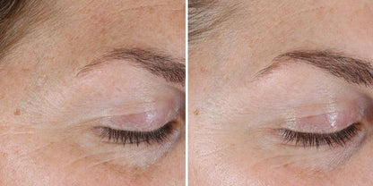 Before and after results showing reduced fine lines with Alastin Skincare Renewal Retinol .25