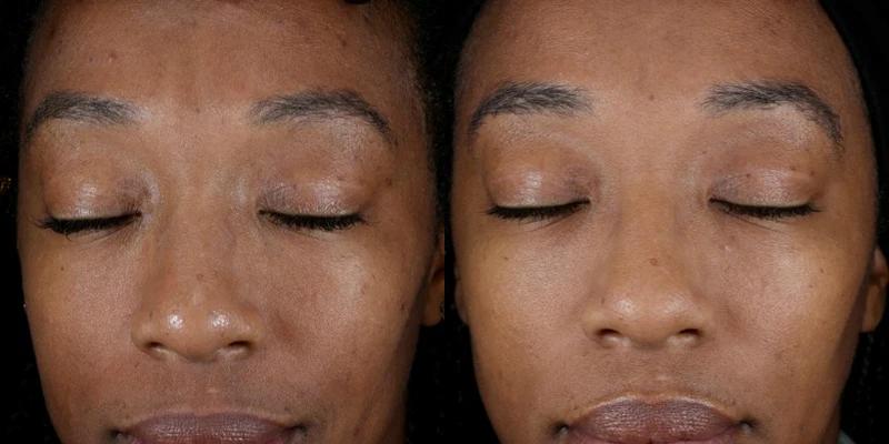 Before and after using Alastin Renewal Retinol .5, improved skin tone and texture