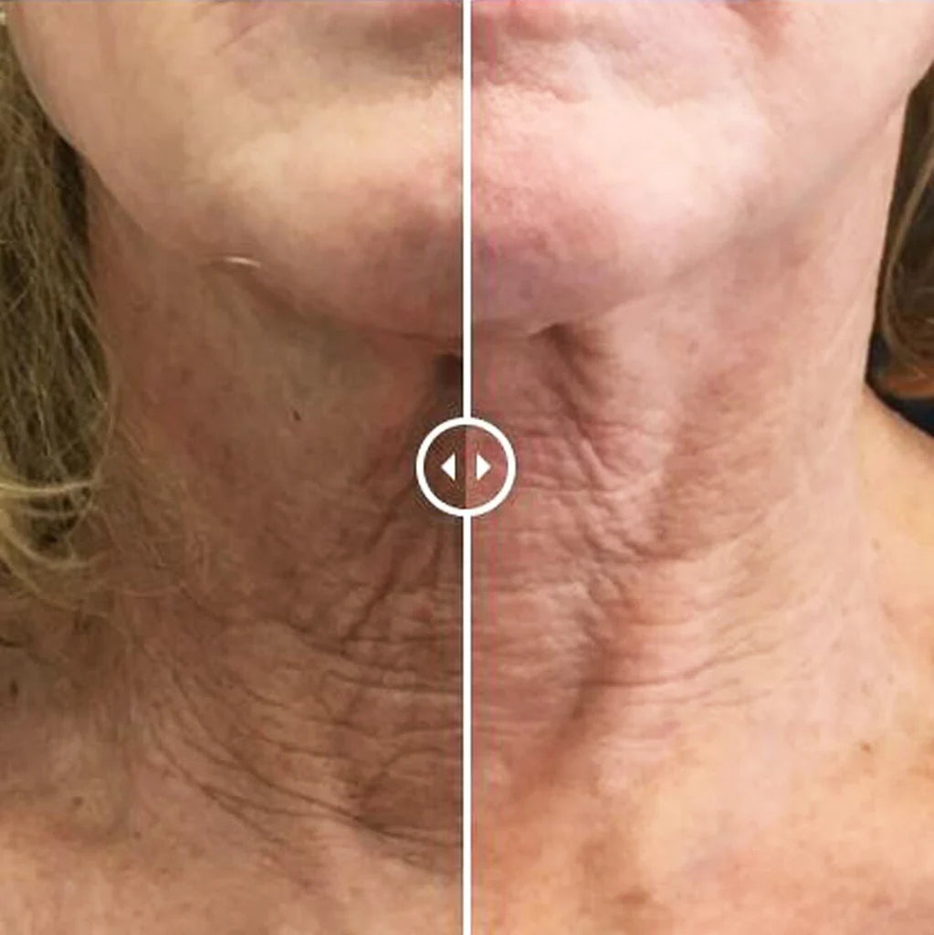 Before and after using Alastin Restorative Neck Complex, improved skin firmness and reduced neck wrinkles