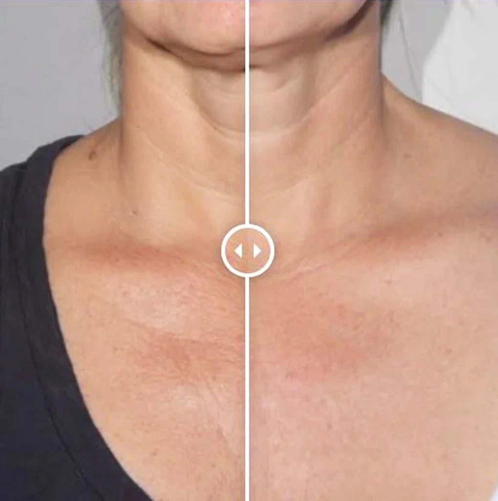 Before and after using Alastin Restorative Neck Complex, improved skin texture and reduced neck lines