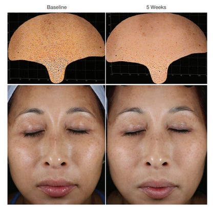 Before and after using Alastin Restorative Skin Complex, improved skin density and texture, 5-week results